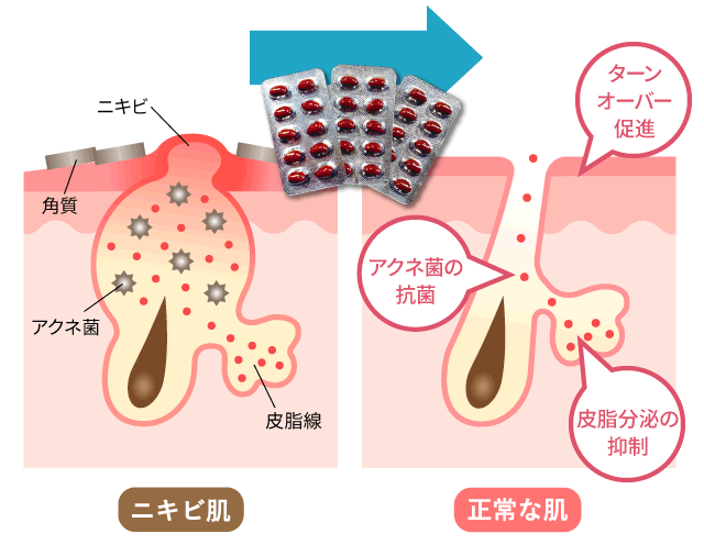 イソトレチノインの効果